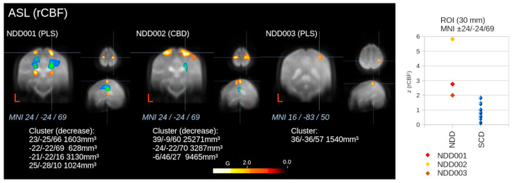 Voxel-wise statistical comparisons in three patients with neurodegenerative diseases (NDDs; primary lateral sclerosis [PLS] for NDD001, corticobasal degeneration [CBD] for NDD002, and PLS for NDD003) regarding relative cerebral blood flow (rCBF) from arterial spin labeling (ASL) by whole brain-based spatial statistics (WBSS) against 19 individuals with subjective cognitive deficits (SCD), considering false-discovery rate (FDR) adjustments. Maximum of cluster coordinates (in Montreal Neurological Institute [MNI] space) and sizes are provided. Hot color clusters indicate decreases, while cold color clusters (in NDD001 and NDD002) indicate increases in rCBF. Additionally, region of interest (ROI) analysis results for ROIs in the motor cortex are shown in comparison to subjects with SCD. “L” indicates the left hemisphere.