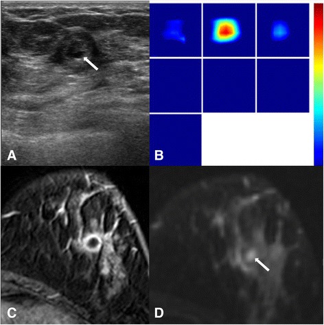 A woman with invasive ductal carcinoma (a) A gray-scale ultrasound image shows an isoechoic mass with central markedly hypoechoic component (arrow), which can present central necrosis (high histologic grade, LVI (−), ER(−), PR(−), HER-2 (−), Ki-67 (+)). b A reconstructed optical absorption map shows a distinct mass with a high maximum THC of 377.3 μmol/L with central prominent high signal. c dynamic contrast-enhanced MRI shows a round mass with rim enhancement with central non-enhancing area, correlated with central hypoechogenicity on US (a) and high signal intensity (arrow) on T2 weighted image (d). The K trans is 0.132 [1/min], the k ep is 0.521 [1/min] and the SER is 1.002. The surgical specimen shows central necrosis