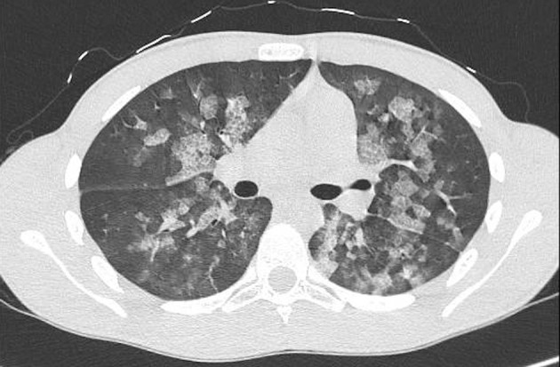 Chest CT scan without contrast medium confirming the diagnosis of DAH.