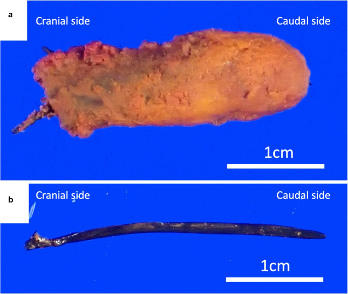 The extracted common bile duct (CBD) stone. Insoluble calcium salts aggregated and formed stones around the fish bone that acted as a nidus (a). The fish bone was approximately 3 cm in length (b)
