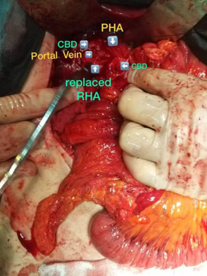 Had replaced right hepatic artery