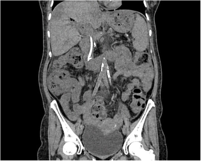 CT of the abdomen and pelvis showing the biliary stent in good position and reflux of air in the left lobe of liver.