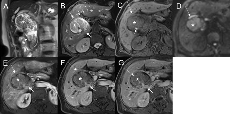 Malignant transformation of adenoma, with three lesions in the common hepatic duct and common bile duct. The first eccentric mass, with a frond-like superficial appearance (*), shows hyperintensity on T2WI (A, B), hypointensity with speckled hyperintensity (short arrow) on the T1WI (C), hyperintensity on DWI (D), and slight continuous enhancement (E–G). The second lesion, presenting as a plaque-like mass (long arrow) shows hyperintensity on T2WI (B), hypointensity on the T1WI (C), hyperintensity on DWI, and hyperintensity on DWI (D). The T1-postcontrast arterial phase (E), portal phase (F), and delayed phase (G) all show slight enhancement. The bile duct wall is thickened at the base of the lesion (thick arrow). The third lesion, presenting as an eccentric mass (arrow), is hyperintense on coronal T2WI (A). The bile duct upstream and at the site of the most distal lesion is seen dilated on coronal T2WI (A).