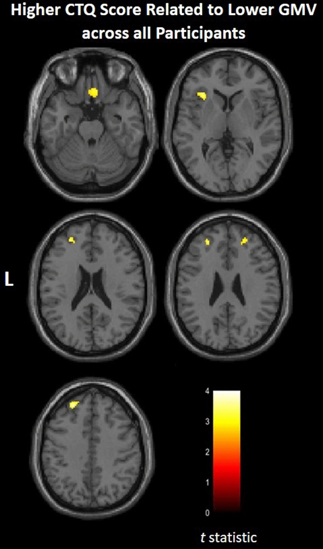 Areas of gray matter volume that related to childhood maltreatment. Axial-oblique images show regions where gray matter volume (GMV) inversely correlated with Childhood Trauma Questionnaire (CTQ) total scores across all participants [total N = 47; participants without a first-degree family member diagnosed with bipolar disorder (FH−): N = 26; participants with first-degree family member(s) diagnosed with bipolar disorder (FH+): N = 21]. Significance threshold is p < 0.005, uncorrected; clusters > 20 voxels. Left of figure denotes left side of brain. Color bar represents range of T values.
