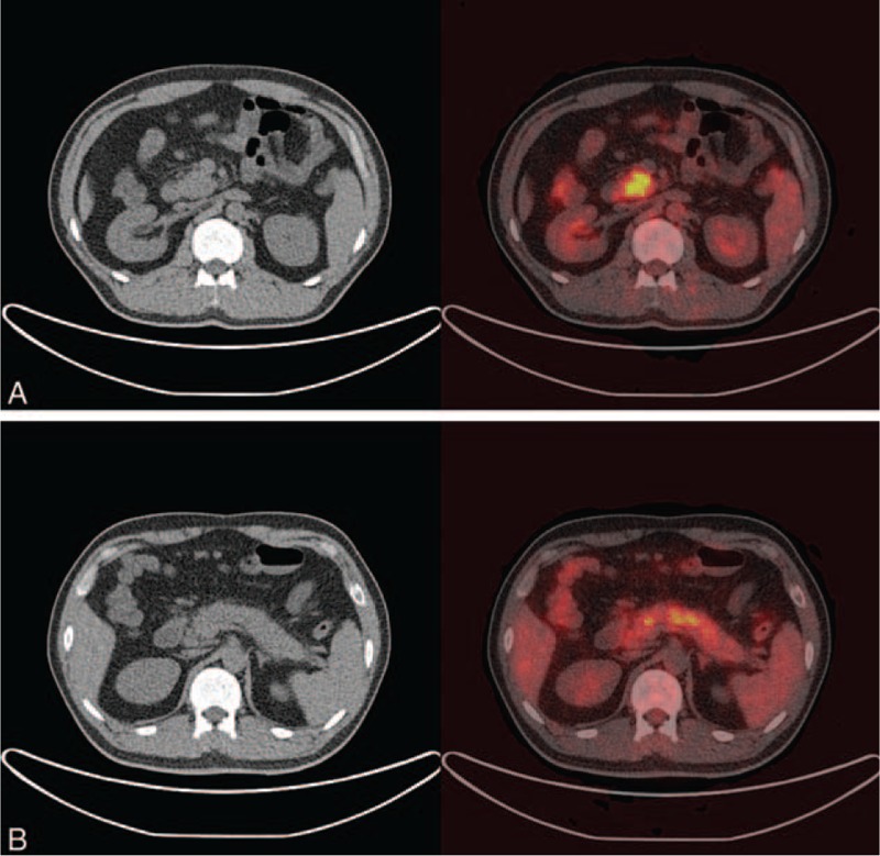 Positron emission tomography/computed tomography body imaging demonstrates (A) a swollen uncinate process of the pancreas with increased uptake, which is suspicious for malignancy, and (B) diffusely increased uptake in the body of pancreas, which is suspicious for secondary inflammation.