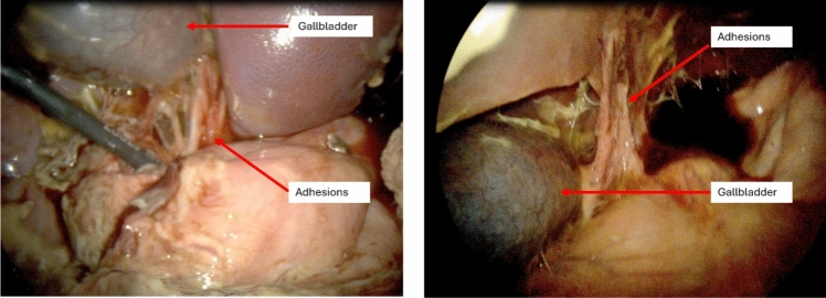 Swine #2 – Initial laparoscopic imaging of the abdomen during the second surgery, revealing significant intraperitoneal adhesions and inflammation