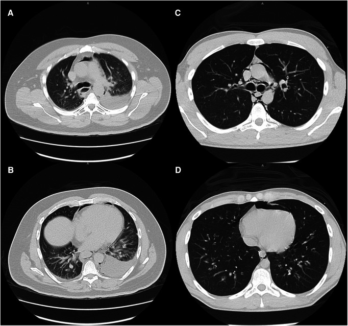 Typical CT scan findings of esophageal perforation (patient 13, images A and B) and marijuana-associated pneumomediastinum (patient 27, images C and D) at similar levels. Moderate to large pleural effusions are typically associated with esophageal perforation. None of the marijuana-associated sPMD patients presented with pleural effusions.