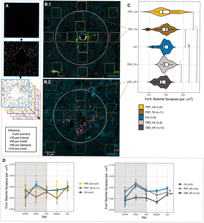 Synapse loss is associated with the territory of APs. (a) Workflow for evaluating astrocytic domain‐associated synapse densities. Bins/ROIs (colored boxes in b) are placed at Sholl‐like, concentric circles surrounding the astrocyte’s core, while somatic targets of the HOMER1 antibody are excluded. Once extracted from the raw image, all bins belonging to one of the five distance representations from “center” to “out” were individually processed and subjected to puncta detection. Merged values of bins belonging to the same distance representation were positioned accordingly and the resulting sequence defined as “synapse distribution.” (b) Exemplifying the image source for the analysis of domain‐associated synapse density AT8 and HOMER1 in TAs in PSP (b.1) and APs in CBD cortices (b.2), where squares delineate bins to extract synapses from. The white circle delimits the astrocytic domain by a priori knowledge. Assignments were given as follows: “center” = light blue, “close” = orange, “mid” = purple, “distant” = pink, “out” = light green. (c) Reduced synapse density in the territory of APs. Combined box‐violin plots depicting the synapse densities of only those bins, which were located within the ascribed astrocytic domain (white circle in b). Comparisons between TAs (golden yellow) / APs (dark grey) and internal AT8‐ control astrocytes (yellow, light grey) of the same condition or external AT8‐ controls (blue) of non‐diseased control subjects. Boxplot description follows Figure 1a. T‐test assuming normal distribution, where #: p < 0.075, *p < 0.05 and ns: “not significant”. (d) Inherent differences among synapse density distributions within the domains of APs. Means of synapse densities are plotted against area representation assignment for TA and CA in PSP, AP, and CA in CBD and astrocytes in corresponding control cases (left: PSP, right: CBD). The extent of the presumed astrocytic domain is delimited as grey, boxed background. Results are expressed as ±SEM, *p < 0.05, **p < 0.01, two‐way‐ANOVA with Leven’s testing for normality and Games‐Howell post hoc test. CA, control astrocytes