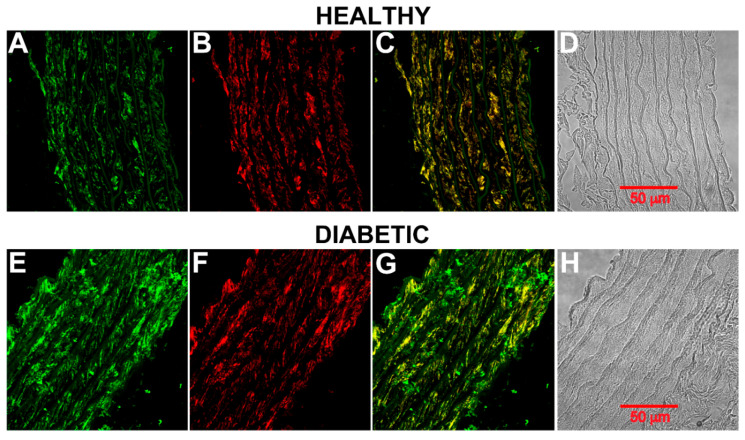 Phosphorylated CB1 receptor on rat aortic smooth muscle. (A) Healthy rat aortic ring showing CB1 receptor (green) and (B) smooth muscle α-actin (red). (C) An overlay of (A) and (B). (D) Bright-field microscopy image of the aortic ring. (E) Diabetic rat aortic ring (8 weeks) showing CB1 receptor (green) and (F) smooth muscle α-actin (red). (G) An overlay of (E) and (F). (H) Bright-field microscopy image of the aortic ring.