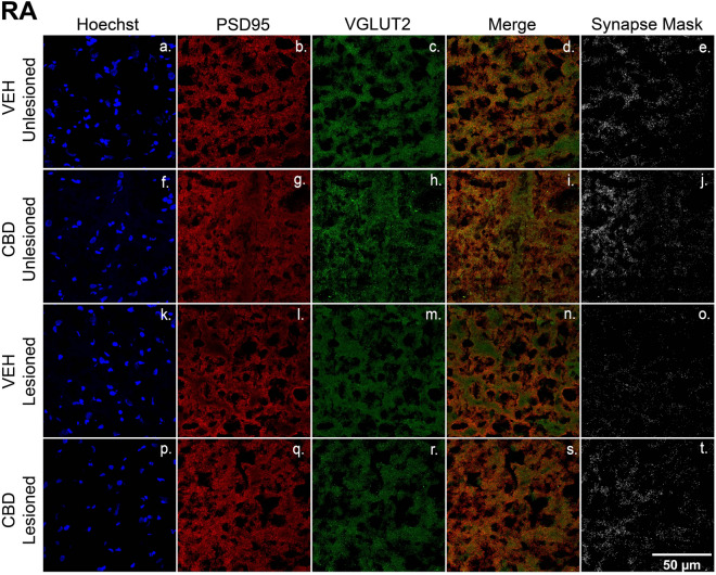 CBD treatments protect glutamatergic synaptic densities from lesion-related losses within RA. (a–t) Representative confocal images of immunofluorescence illustrating synaptic density in four groups: VEH Unleisoned (a–e), CBD Unlesioned (f–j), VEH Lesioned (k–o), and CBD Lesioned (p–t). Stain is divided into columns with Hoechst, PSD95 (postsynaptic marker), and VGLUT2 (presynaptic marker) respectfully. Column four is a merge of the two stains and column 5 shows a mask of the colocalized puncta of PSD95 and VGLUT2. The synapse masks show that relative to VEH controls CBD groups have significantly higher glutamatergic synapse densities 24 h postlesions.