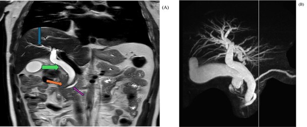 MRI coronal T2 haste (A) showing abrupt cut-off of the distal CBD with a dilated common bile duct, mild degree of intrahepatic biliary dilatation and mild dilatation of the pancreatic duct. MIP image (B) shows the cut off at the distal CBD, with severe dilatation of the extrahepatic and intrahepatic biliary tree, as well as dilated pancreatic duct.