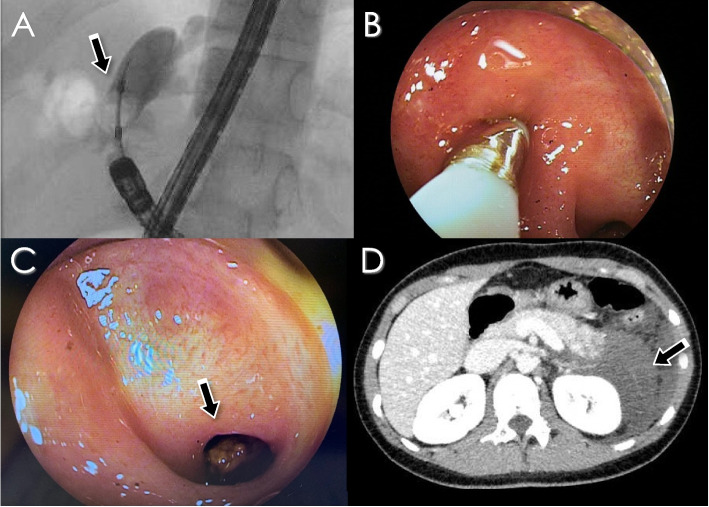 DB-ERC findings and acute pancreatitis after intervention (Case 3). A Cholangiography and balloon dilatation of right hepatic duct stricture. B In DB enteroscopy, the stone was crushed using a crusher catheter. C Arrow shows the IHBD stone. D Enhanced abdominal CT shows decreased enhancement and swelling of the pancreatic tail 1 day after DB-ERC