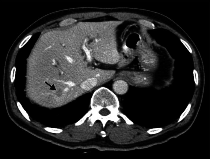 Abdominal computed tomography scan for preoperative evaluation shows small nodular lesion with peripheral enhancement in S7, suggesting liver metastasis (arrow).
