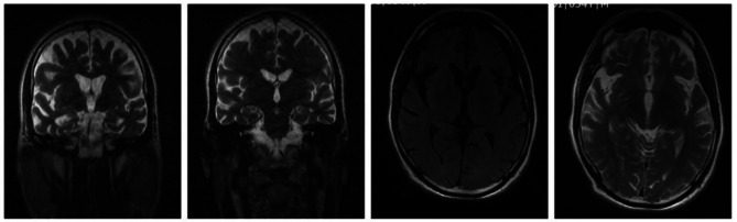 Brain magnetic resonance imaging (MRI): Frontotemporal lobar degeneration and cortical brain atrophy are more significant in the frontal, parietal and temporal lobes