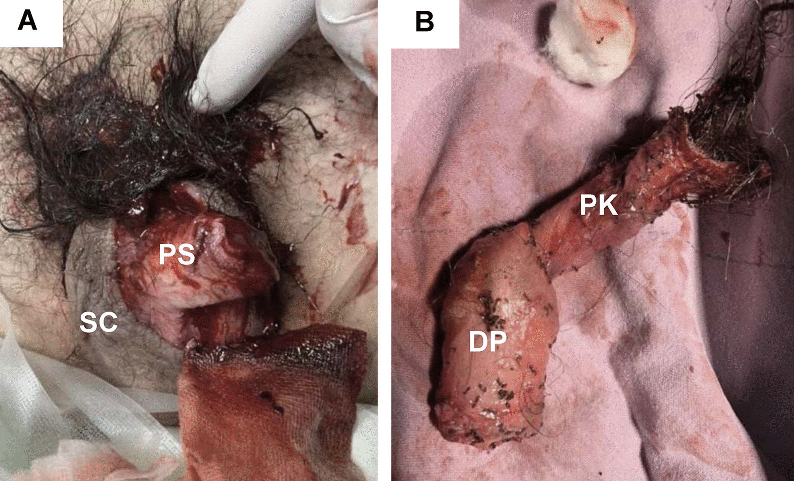 A The remaining penile stump. B The amputated distal penis. DP amputated distal penis, PS penile stump, PK penile skin, SC scrotum