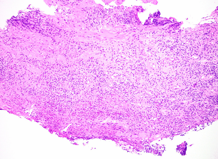 Histological image of the distal esophageal biopsy specimen. Hematoxylin and eosin stain of the patient’s distal esophageal mucosal biopsy specimen demonstrating granulation tissue with acute on chronic inflammation. Photograph provided by Dr. Vikram Deshpande (Massachusetts General Hospital)