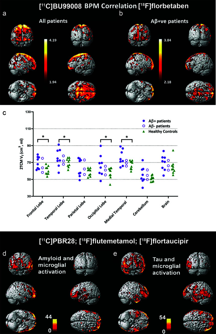 Biological parametric mapping (BPM) correlation between [11C]BU99008 and [18F]florbetaben binding in (A) all cognitively impaired (CI) subjects and in (B) Aβ-positive cognitively impaired subjects at a cluster threshold of p < 0.05 with an extent threshold of 50 voxels. These BPM are T maps describing the strength of the voxel-wise correlations between binding of the two radioligands represented in a common brain space. (C) Dot plot demonstrating the regional [11C]BU99008 total volumes of distribution (Vt) using two-tissue compartmental models in Aβ-positive cognitively impaired subjects (purple filled circle), Aβ-negative CI subjects (purple open circle), and healthy controls (HC, green triangle). “Brain” refers to the composite cortex, combining all the major cortical regions. *p < 0.05, uncorrected. Reproduced from (176) with permission from Springer Nature. (D, E) Voxel-level correlation between [18C]PBR28, [18F]florbetapir, and [18F]flutemetamol in the patients with mild cognitive impairment and Alzheimer’s disease who were positive for all three tracers. (D) Voxel-level correlations between microglial activation assessed by using [18C]PBR28 and tau aggregation assessed by using [18F]florbetapir. (E) Voxel-level correlations between microglial activation assessed by using [18C]PBR28 and amyloid deposition assessed by using [18F]flutemetamol. Reproduced from (69) with permission from Oxford University Press.