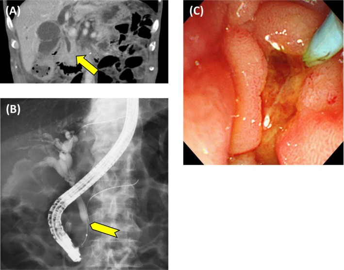 Contrast‐enhanced imaging revealed obstructive cholangitis secondary to CBD obstruction, with no evidence of direct invasion or mass‐like lesions indicative of malignant retroperitoneal fibrosis (A, arrow). Endoscopic retrograde cholangiopancreatography demonstrated beak‐like narrowing of the bile duct, suggestive of external compression (B, arrowhead), along with poor duodenal dilatation and edematous mucosa of the major duodenal papilla (C).
