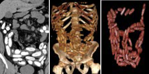 A. CT abdomen-coronal image, B. 3D volume rendering image, C. 3D volume rendering image with bone subtraction.