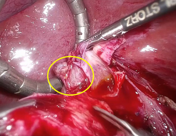 Intraoperative findings. A cystic structure on the ventral side of the common hepatic duct, slightly to the right (circle), is diagnosed as an ectopic gallbladder during dissection of the common hepatic duct. The distance between the cystic duct and bifurcation is estimated to be 1.5 cm. The ectopic gallbladder is resected