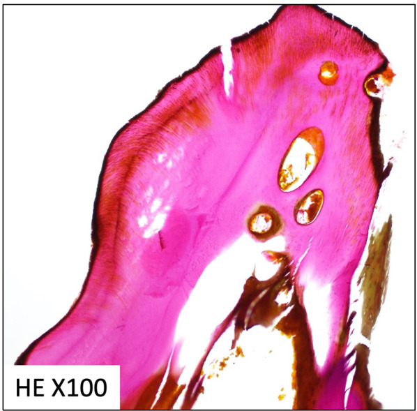 Histological hematoxylin–eosin (HE) staining of the needle-shaped foreign body. The bone matrix that was constructed with collagen fibers was dyed red with hematoxylin