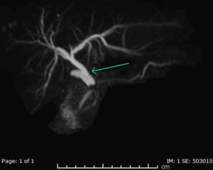 MRCP demonstrating cystic duct stump compressionMagnetic resonance cholangiopancreatography (MRCP) shows a dilated long cystic duct stump with an impacted stone causing abrupt narrowing of the distal common bile duct (CBD) (green arrow). Associated dilatation of the proximal intrahepatic biliary ducts is also demonstrated.