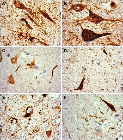 Representative hippocampal pThr231 tau pathology. a AD, b ALSci, c DLBD, d mDLBD, e FTLD, f MSA. Counterstained with hematoxylin. Original images taken at 100×