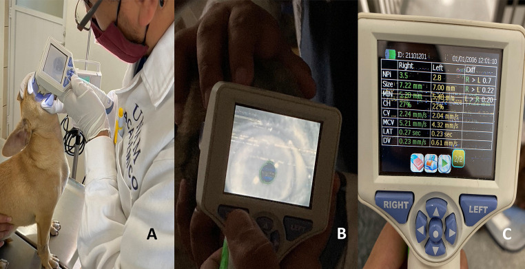Methodology of the infrared pupilometry technique. (A) The placement of the pupilometer at a 90° angle in the ocular region is depicted. (B) The moment of measuring the pupil diameter using the infrared light camera is shown. From the pupil diameter measurement, 7 different variables are captured, including the neurological pupil index (NPi), size, minimum diameter (MIN), percentage change (% CH), constriction latency (LAT), constriction velocity (CV), and maximum constriction velocity (MCV), as shown in image C.