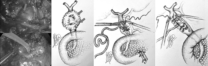Large defect in CBD, closure over T-tube