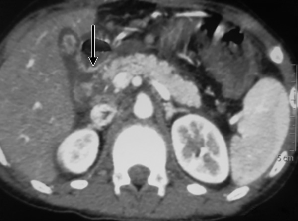 Contrast enhanced computed tomography scan showing an ill-defined collection in the Morrison’s pouch and mild free fluid in the peritoneal cavity