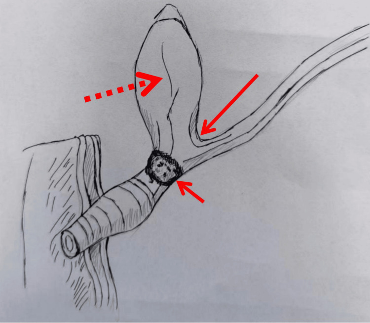 A sketch of anomalous pancreaticobiliary ductal union (APBDU) with giant pancreatic duct calculi in the common channel.The dashed arrow indicates the elongated residual common bile duct. The long, solid arrow indicates a P-B-type APBDU, and the short, solid arrow indicates the formation of stones at the confluence of the bile and pancreatic ducts.Image hand-drawn by the authors.