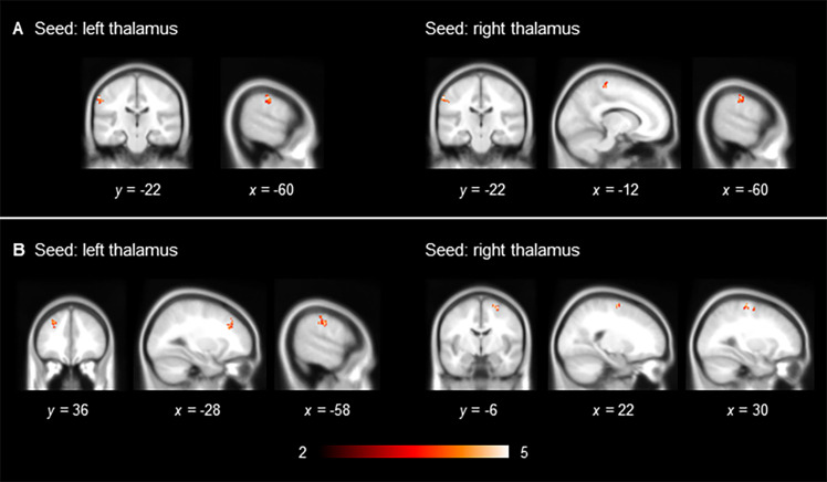 Significant increase in thalamic functional connectivity in adult cannabis non-users with a childhood diagnosis of ADHD compared with cannabis non-users without a childhood diagnosis of ADHD.(A) Scrubbing (+), global signal regression (−) and (B) scrubbing (−), global signal regression (−). Results are displayed at a family-wise error-corrected cluster-defining threshold of p < 0.025.