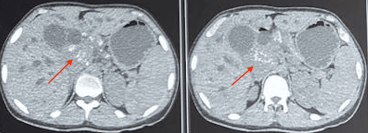 Contrast-enhanced CT (CECT) abdomen showing a periportal lymph nodal massAxial CECT images of the abdomen demonstrate a heterogeneous, enhancing soft-tissue mass in the periportal region (red arrows). The lesion is seen encasing and compressing the common bile duct, resulting in upstream biliary dilatation.