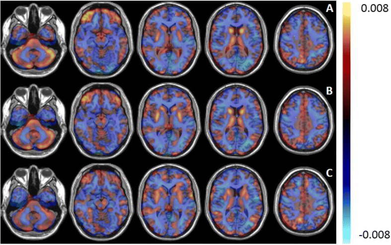 Discriminative patterns (arbitrary units) between ALS and PP determined by PCA-LR (a), PCA-SVM (b), and SVM (c). The values in each voxel represent the weights of the contribution of the voxel for the classifier. Positive values (red) indicate regions of relative hypermetabolism of ALS patients compared to PP patients, whereas negative values (blue) correspond to relative hypometabolism of ALS patients compared to PP patients