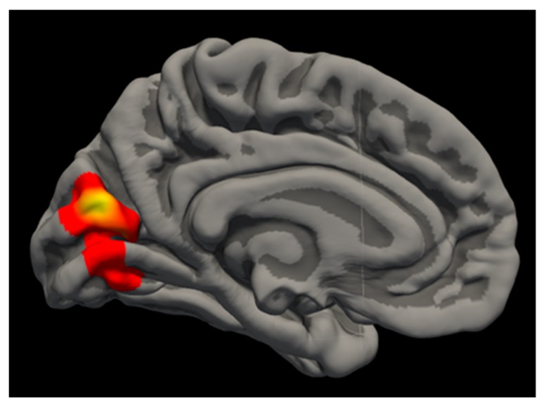 Cannabis Findings. Medial view of cannabis finding within left cuneus SA, with larger area in cannabis users.