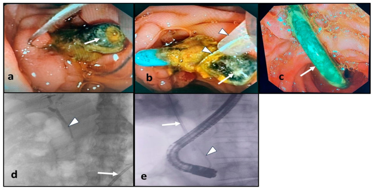 Endoscopic management of the forgotten-biliary-plastic-stent-related complications. (a) Endoscopic image of a clogged biliary plastic stent in situ (arrow); (b) endoscopic image during retrieval of the clogged stent (arrow) using a snare (arrow heads); (c) endoscopic image of a distally migrated biliary plastic stent (arrow), which was accessible for endoscopic retrieval; (d) fluoroscopic visualization of a distally migrated biliary plastic stent (arrow), which was inaccessible for endoscopic retrieval, and presence of cholangiogram (arrow head); (e) fluoroscopic visualization of a proximally migrated biliary plastic stent (arrow) and the guidewire, which was introduced alongside the stent (arrow head).