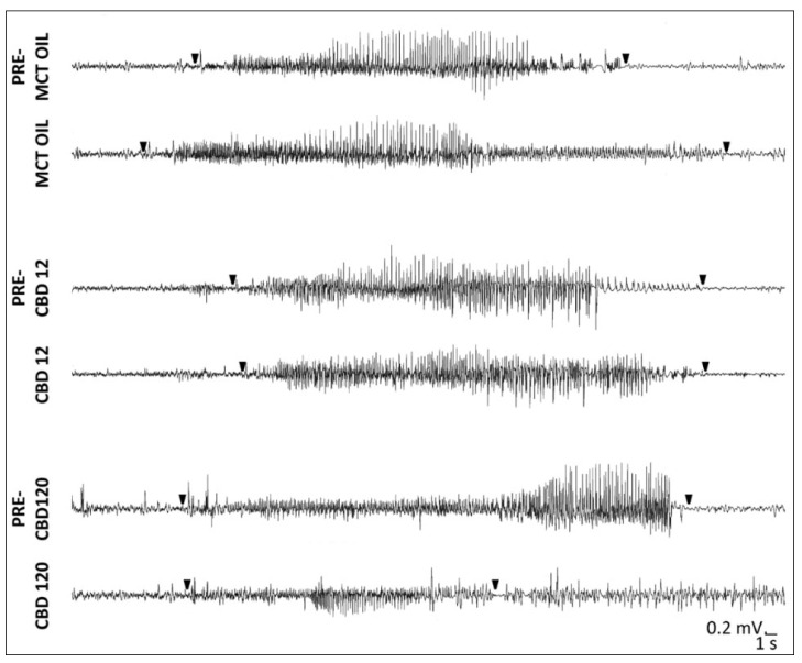 Spontaneous recurrent seizures (SRSs) after induction of status epilepticus in epileptic rats treated with cannabidiol (CBD) at 12 mg/kg, 120 mg/kg, or with medium-chain triglyceride (MCT) oil. SRSs were recorded in rats during the treatment with CBD or MCT oil, but also 3 days before (PRE-MCT OIL, PRE-CBD12, and PRE-CBD120) the treatment. Notably, SRSs during the high concentrations of CBD belong to incomplete responders. Arrowheads represent the onset and termination of SRSs.