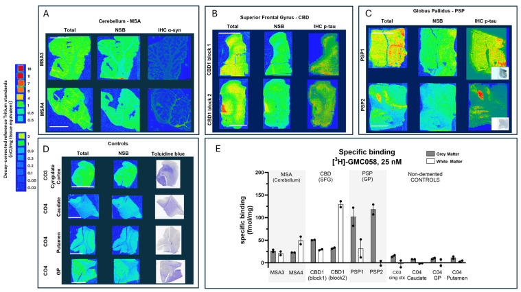 Representative images from autoradiography with [3H]GMC-058 (25 nM) and corresponding immunohistochemistry (IHC) heatmap showing the density of α-synuclein (α-syn) or phospho-tau (p-tau) immunoreactivity on fresh-frozen tissue sections from patients with (A) multiple-system atrophy (MSA); (B) cortical-basal degeneration (CBD); (C) progressive supranuclear palsy (PSP); and (D) non-dementia controls. Non-specific binding was measured with excess (5 µM) of cold blocker (GMC-044). (E) Specific binding (fmol/mg) quantified from gray and white matter regions of interest in all cases. Bars represent the average ± s.e.m. of two technical replicates quantified from each case. Line scale: 10 mm. C04 was negative for pTau, α-Syn, and Aβ; therefore a Toluidine blue stain is shown in (D).