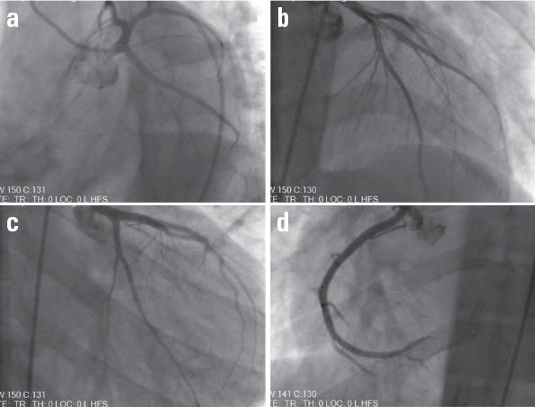 (a–d) CAG showing normal coronary arteries