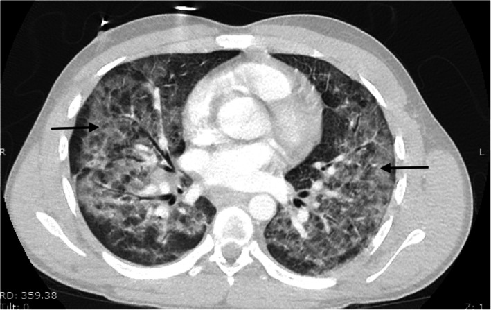 Axial view computed tomographic scan of the chest demonstrating diffuse central predominant interstitial opacities (black arrows)
