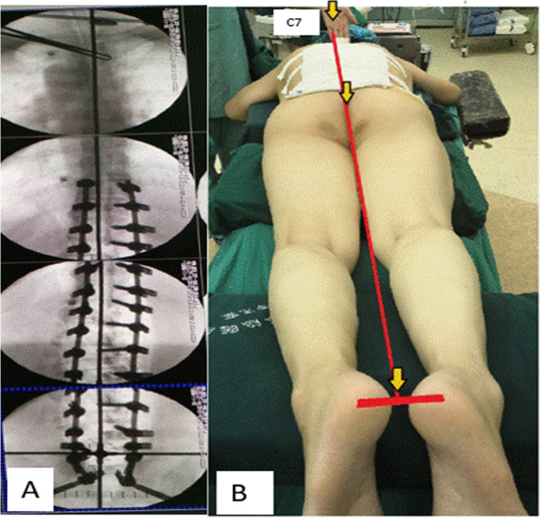 a Checking fluoroscopically if longer vertical limb passed across C7. b A perfect line passing through physical landmarks after IGCA technique. IGCA: integrated global coronal aligner