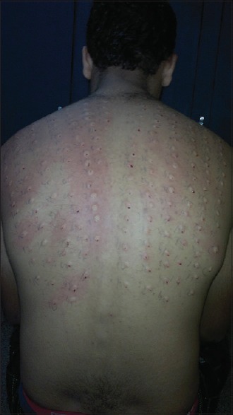 Skin intradermal allergy testing