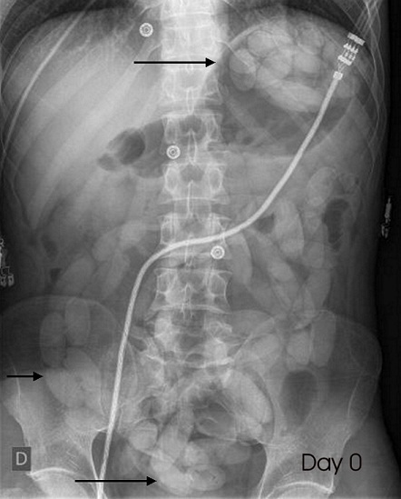 Plain abdominal X-ray at admission with multiple body packers (arrows)