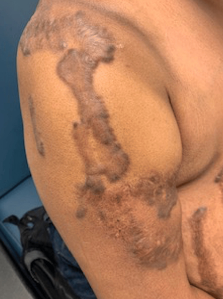 Keloid scar on the arm