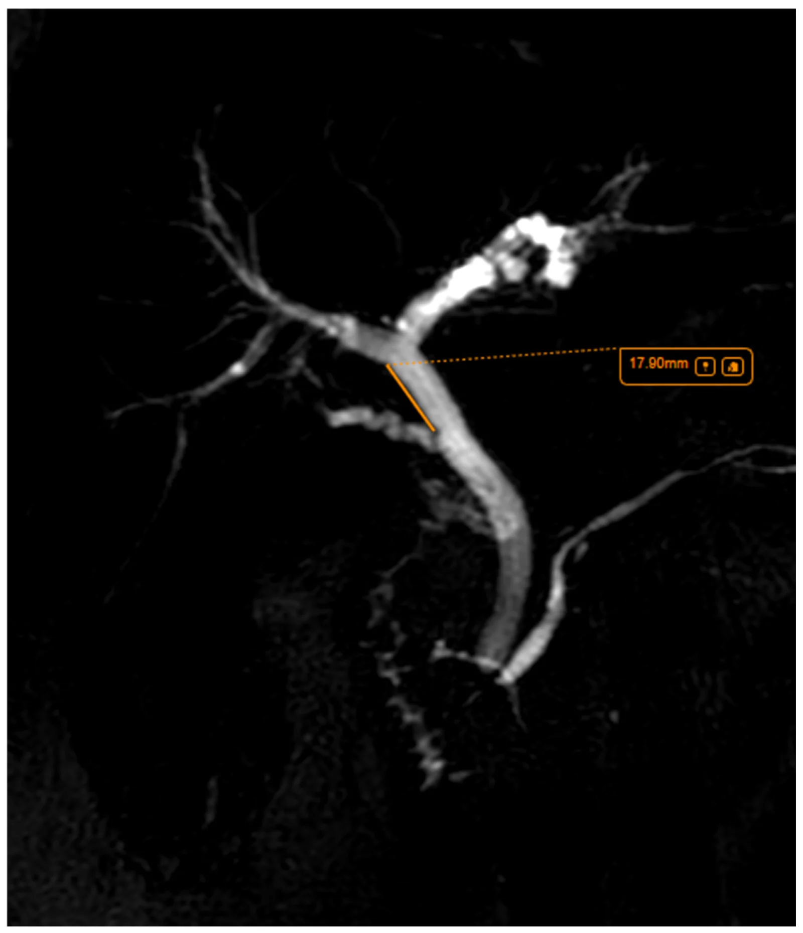 MRCP—cystic duct insertion distance from the hepatic hilum.