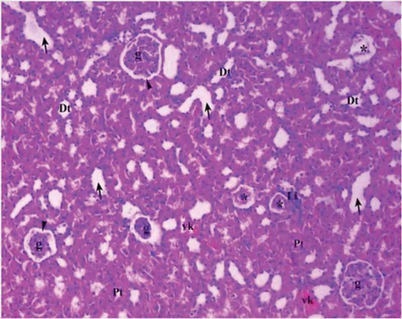 Renal tissue in diabetic control group (Group DM-C). Pt: Proximal tubule, Dt: Distal tubule, g: glomerular, arrow head: bowman space, arrow: dilated tubule Li: Lymphocyte infiltration, vc: vascular congestion, *: degenerated glomerulus (H&EX10).