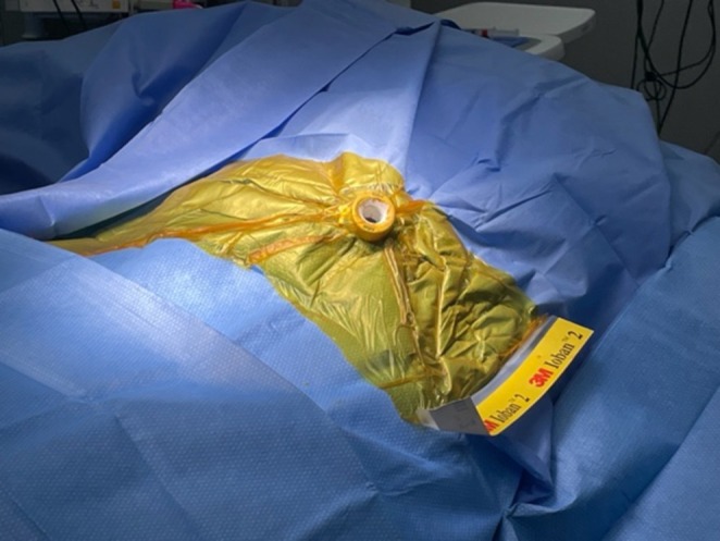 After placement of the 15 mm trocar, the incision is closed, and the sterile field is completely redraped (pictured), allowing the endoscopist controlled access through the trocar, as shown. Upon completion of the endoscopic retrograde cholangiopancreatography (ERCP), the trocar and all overlying drapes are removed en bloc to preserve the sterility of the surgical field. A gastrostomy tube is then inserted through the established trocar site.