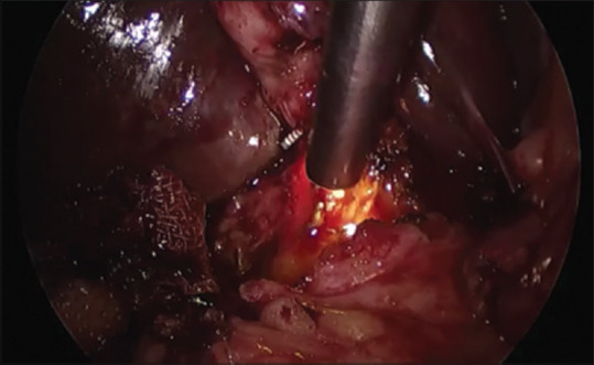 Common bile duct exploration using nephroscope