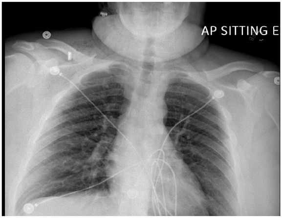 Chest X-ray image: Day 3 showing near complete resolution of previously identified pneumomediastinum and decreased subcutaneous emphysema, with clear lung fields and normal heart size. The right side of the chest appears slightly more aerated, which might be due to the patient’s posture or an underlying condition.