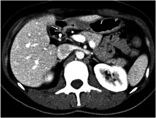 Axial view of an enhanced abdominal CT scan acquired after endoscopic retrograde cholangiopancreatography (ERCP). The image visualizes key upper abdominal structures including the liver, pancreas, and proximal descending duodenum. A white arrow points to the confirmed choledochoduodenal fistula in the proximal descending duodenum, with the previously implanted biliary stent clearly visible within the biliary tract.
